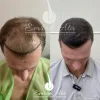 Клиника пересадки волос Dr. Эмрах Ата Изображение 2